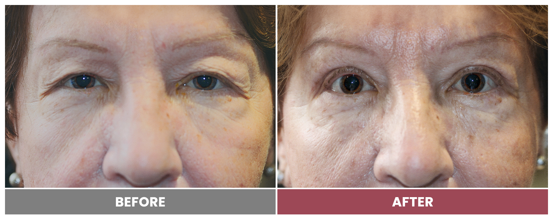 Upper Blepharoplasty - Case 6